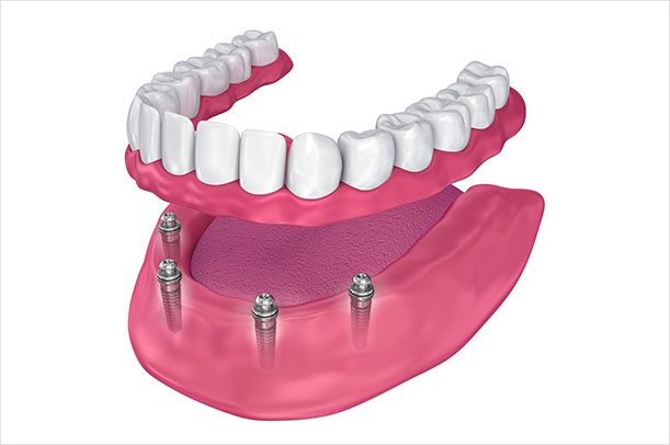 Implant Retained